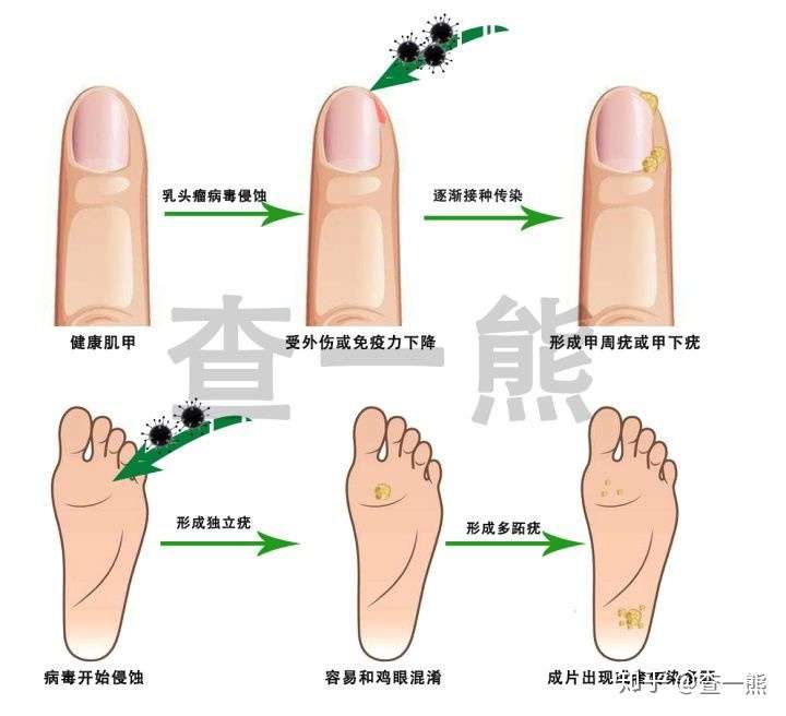 跖疣手册 跖疣你必须知道的那些事 知乎