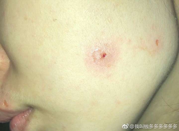 上海九院的點痣效果如何