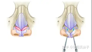 【科普】鼻中隔延长鼻尖