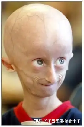 全球首个早衰症药物首创法尼基转移酶抑制剂zokinvy