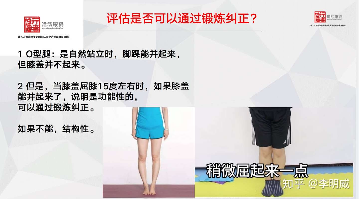 O型腿运动纠正终结版 知乎