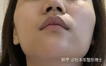 下颌角超长曲线截骨为什么效果好教授为你解答