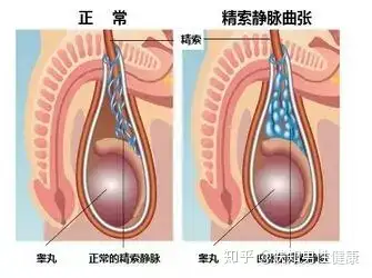 睾丸蚯蚓状血管图片图片