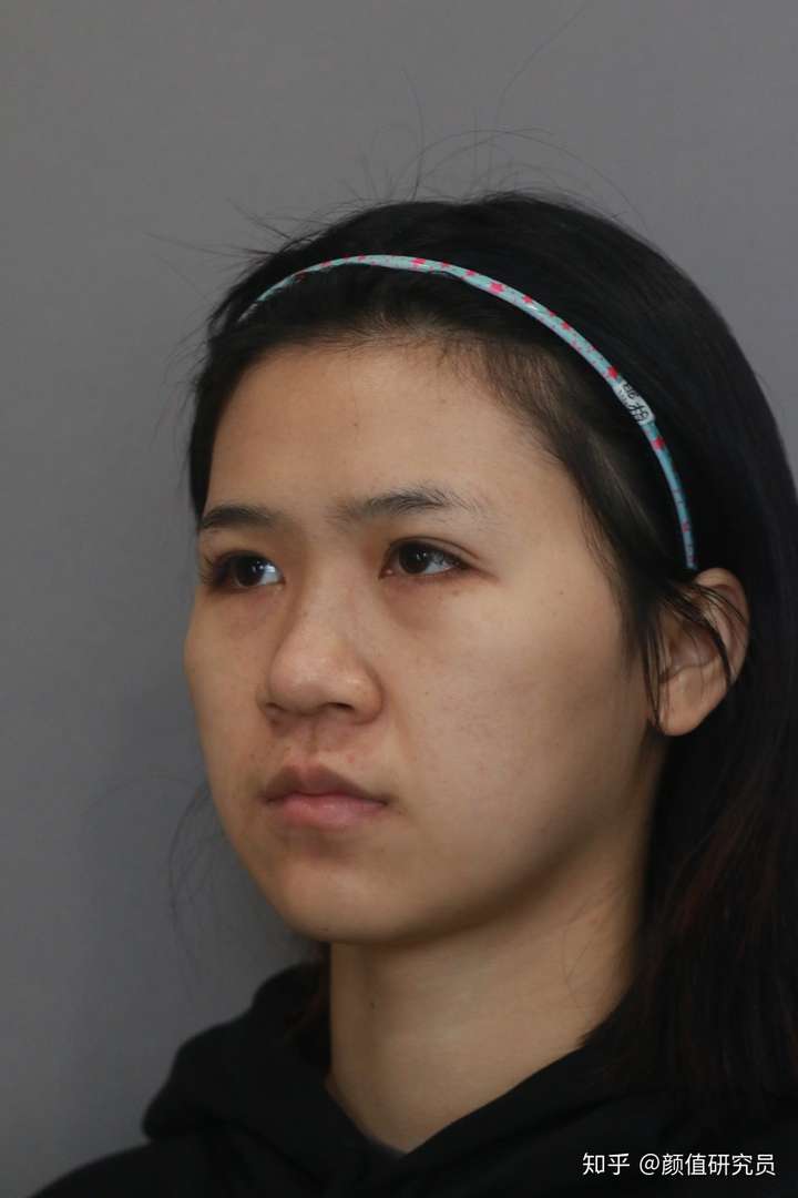 鼻子很挺但是鼻翼很大是什么体验