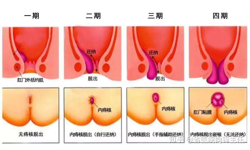 痔疮症状分为几期？ - 知乎