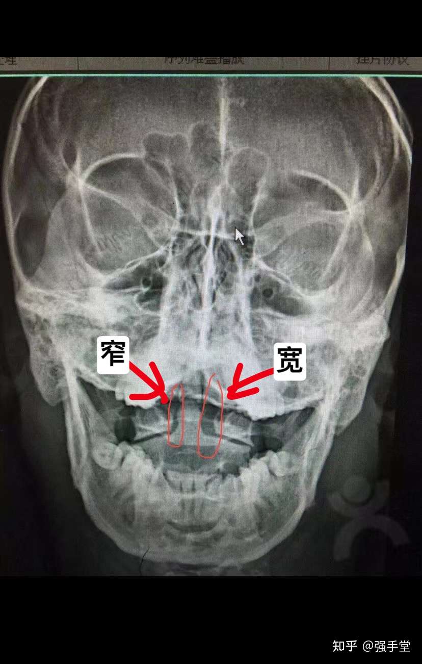 寰枢关节间隙左窄右宽图片