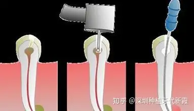 在根管治疗中牙胶尖的作用与功效是什么生物陶瓷牙胶尖的优点有哪些