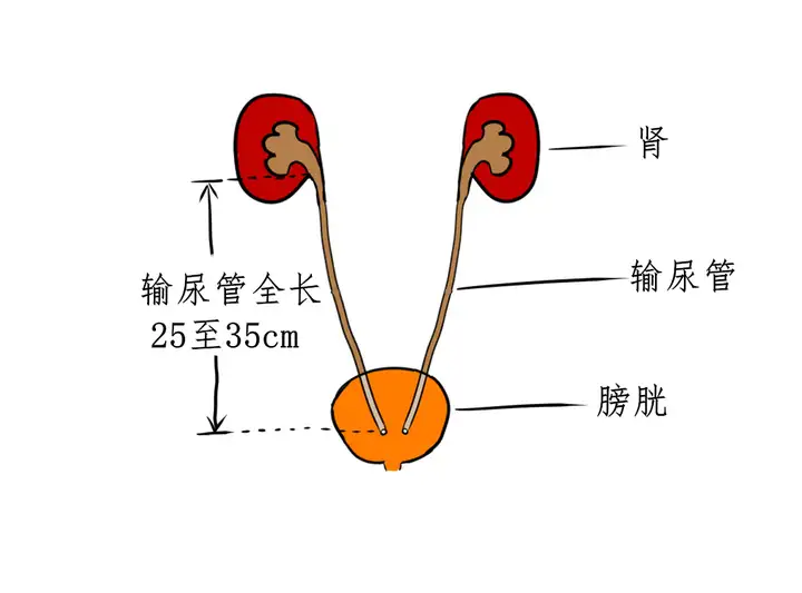 发现输尿管结石应该怎么做呢?