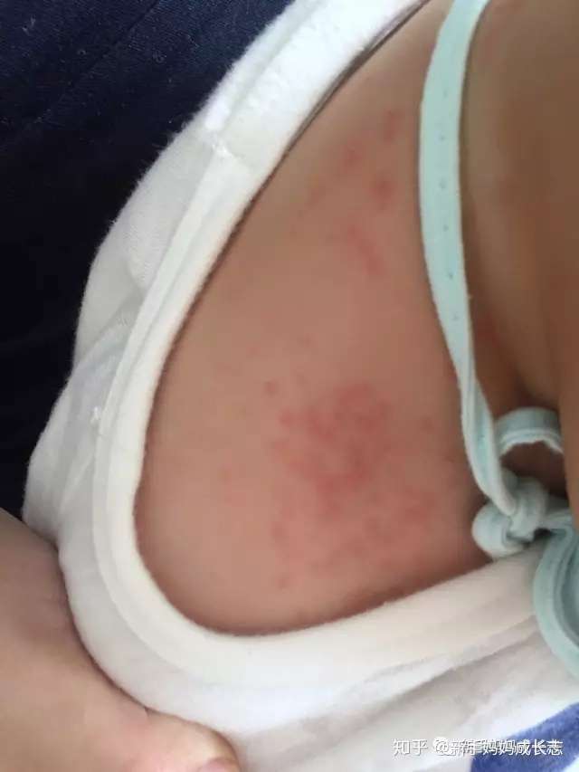 宝宝2岁半了,最近太热额头长了好多痱子,有没有好的方法治疗?