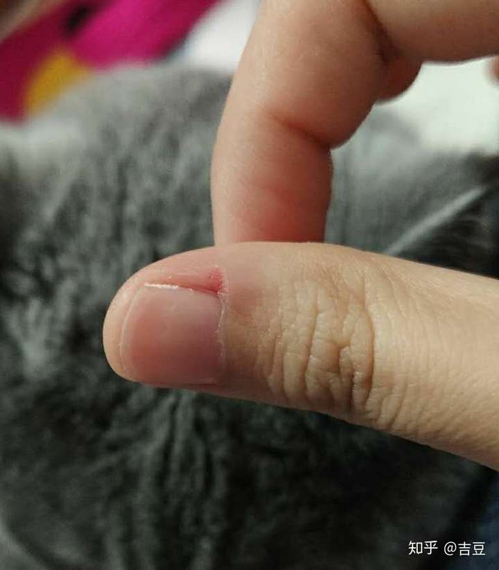 大家喜欢良性自虐吗?比如长跑,撕手上的肉刺?