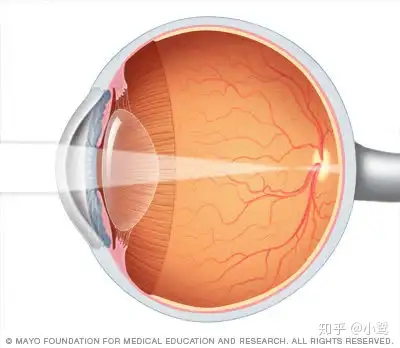 全面瞭解近視手術之飛秒激光lasik