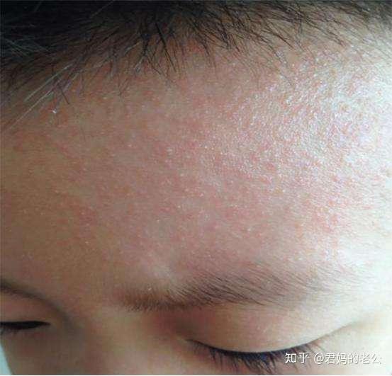 赞同了该文章 家里小慕清四个月大时第一次出现湿疹,刚开始时右侧脸部