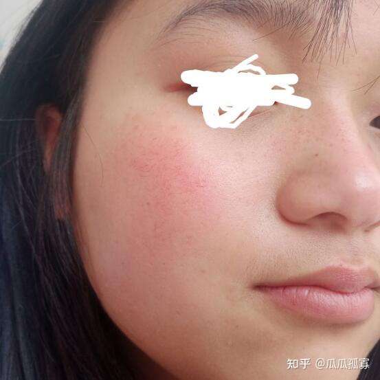 皮肤差是一种什么样的体验?