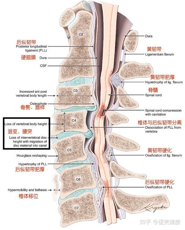 你的腰疼很可能是腰椎间盘突出 这三个评估试验来告诉你答案 知乎