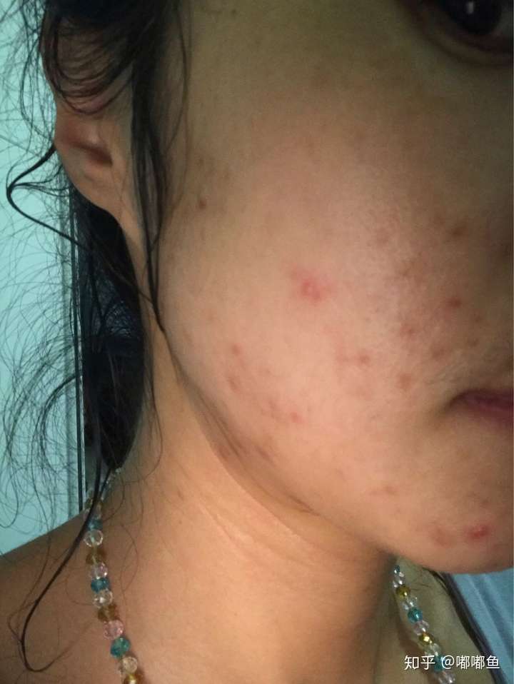 祛痘第二单 - 知乎
