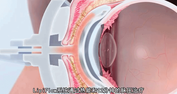 【眼健康科普课堂】干眼治疗新技术LipiFlow落户永州爱尔眼科医院(图6)