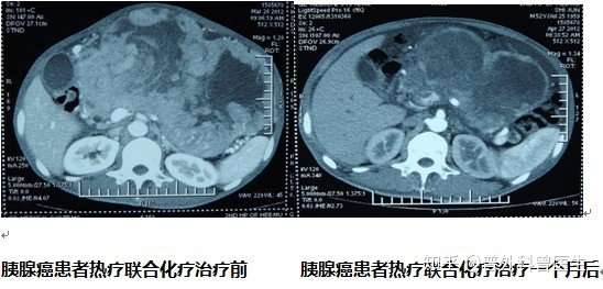 43度就可以杀死癌细胞 如果人发烧到43度 是不是就可以治愈癌症 知乎