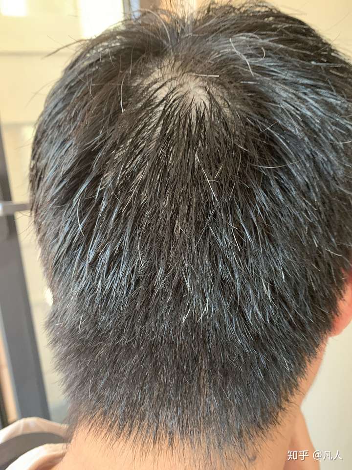 前几年头顶发现张了几根白头发,最近发现白头发特别多了,是什么原因