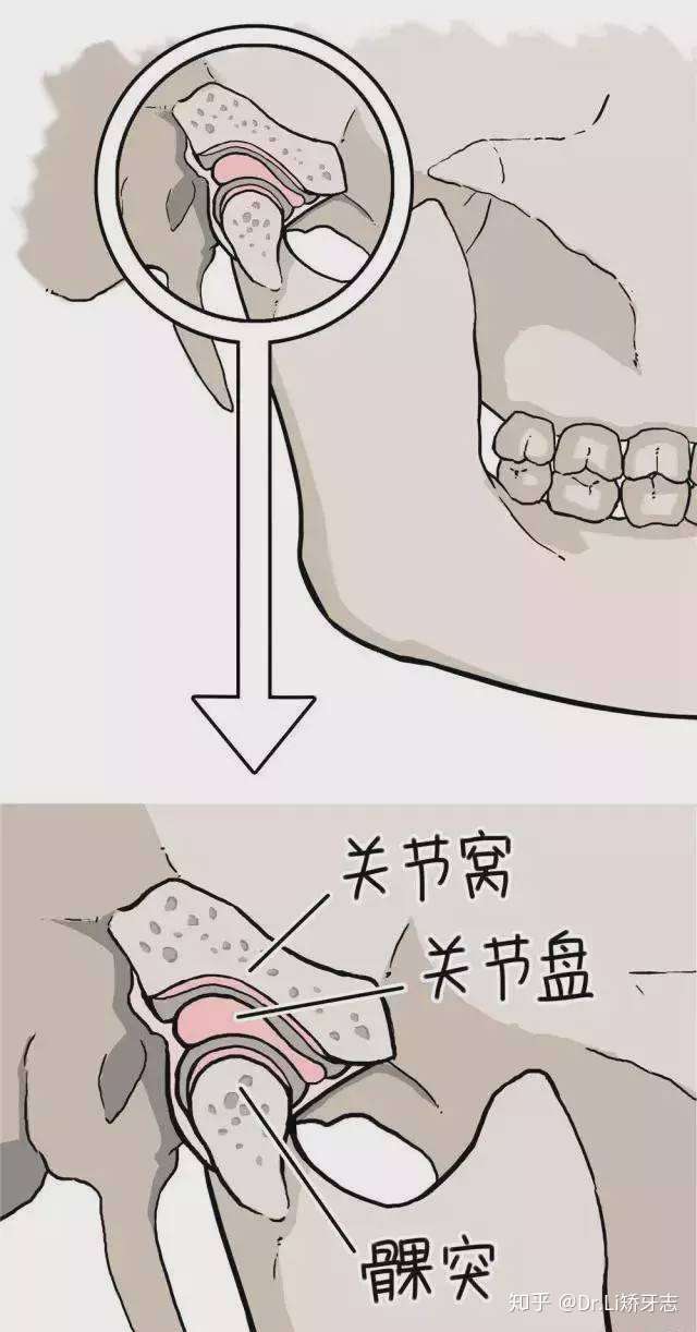 一般来说突然不能张大口(张口受限)或者张口疼痛,是因为关节盘移位