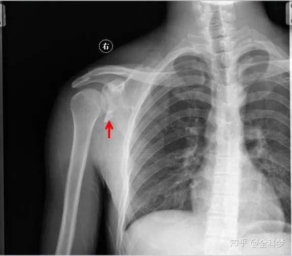 110张经典x线片影像诊断 夜班医生必备 知乎