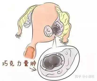 卵巢囊肿可以进行促排卵吗影响试管婴儿成功率