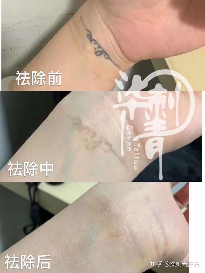 洗紋身是不是比紋的時候還貴?是不是很疼?痕跡明顯不?