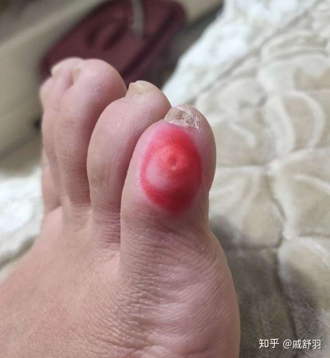 鸡眼这样好了吗