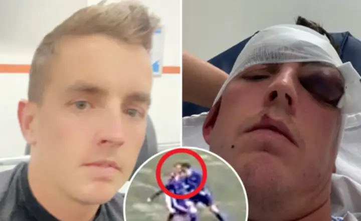 暴力🤕苏格兰一球员遭对手故意头部顶撞，眼睛肿成高尔夫球大小