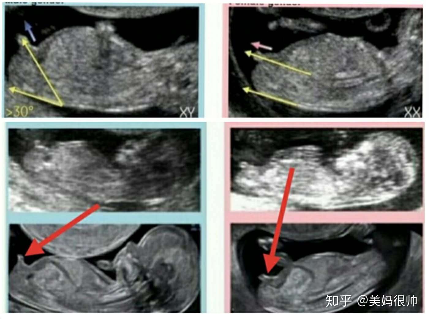 孕3个月男女胎儿差异大 孕妇有这3种 不适 意味胎儿发育好 知乎