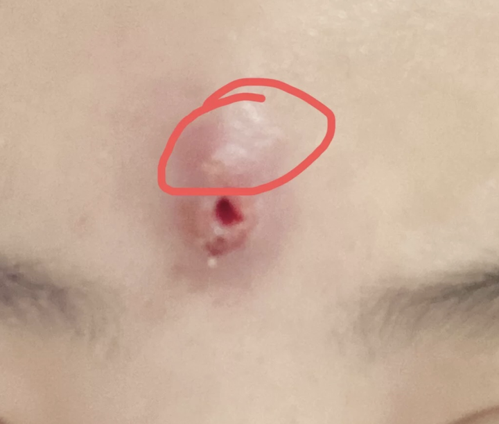 火疖子的病因是什么