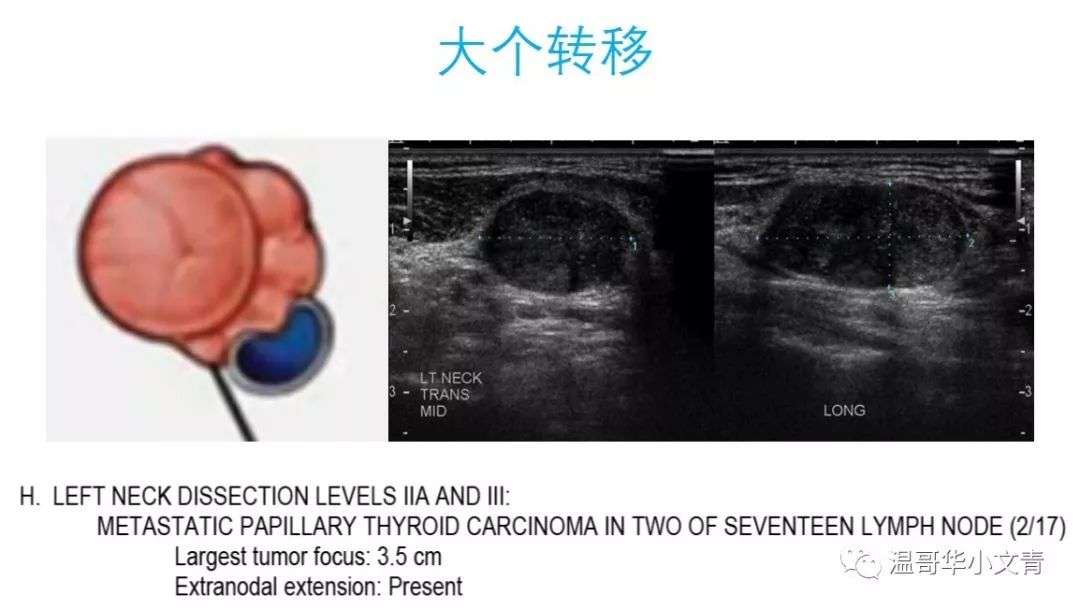 三大奇葩说甲状腺癌的淋巴结转移 知乎
