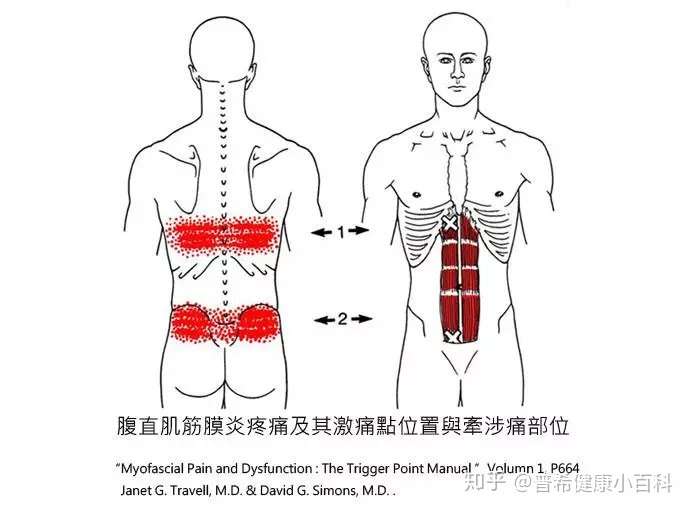 另类腰痛 腹直肌肌筋膜疼痛 知乎