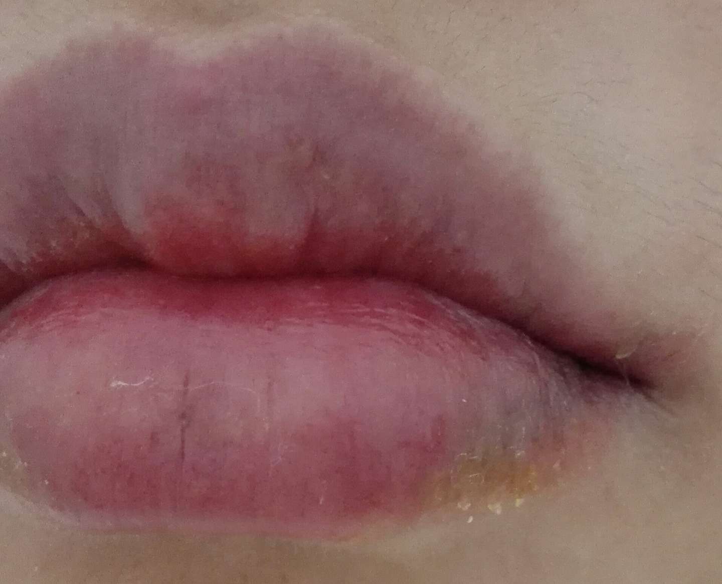 唇炎 请离我远一点 知乎