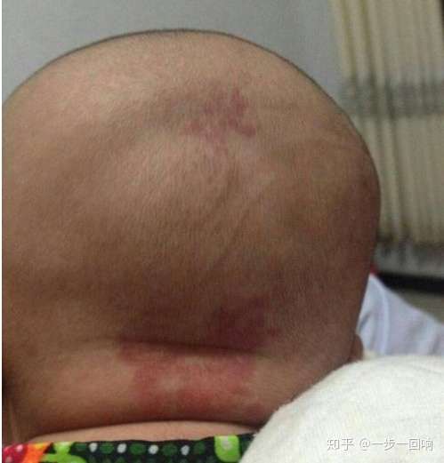 婴儿后脑勺红胎记图片图片