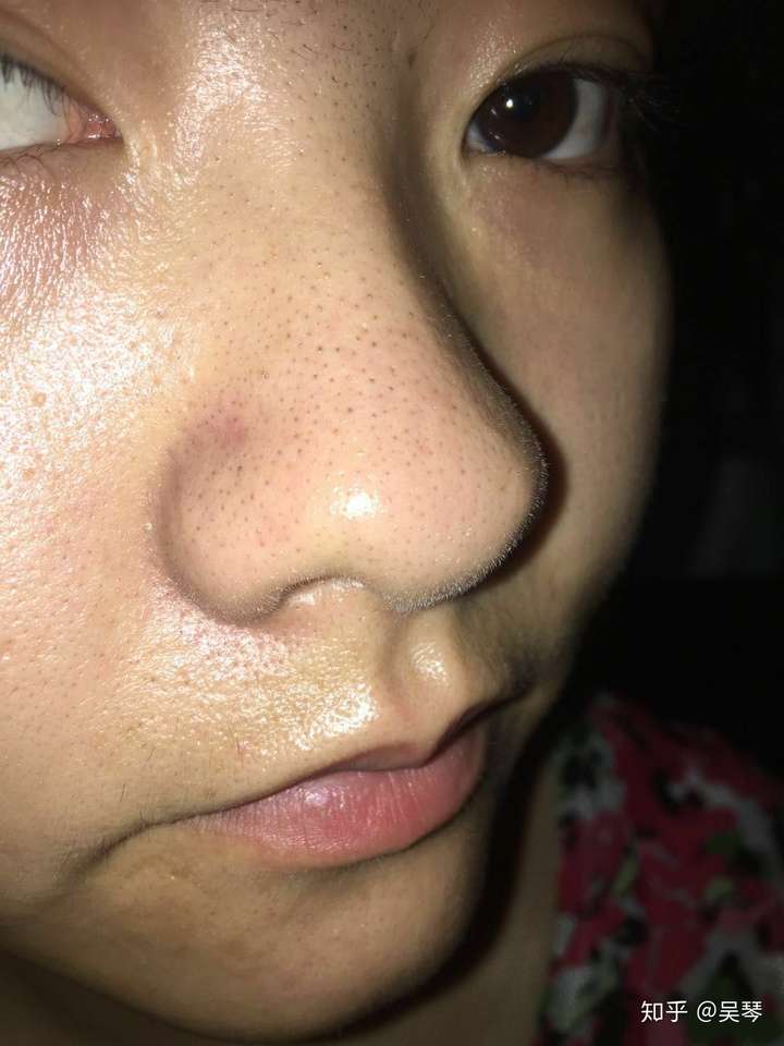 抖音上张文鹤医师说的十滴水洗脸去黑头粉刺是真的吗?