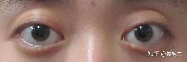 以下情况适 不适合做双眼皮手术的: 眼球突出者(很多高度近视和甲亢