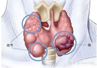 但最近有很多患者反饋,就在觀察的過程中,有的人甲狀腺結節不僅變大了