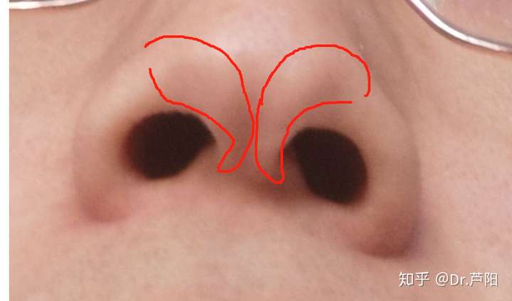 鼻头不对称中间还有一条小坑怎么改善