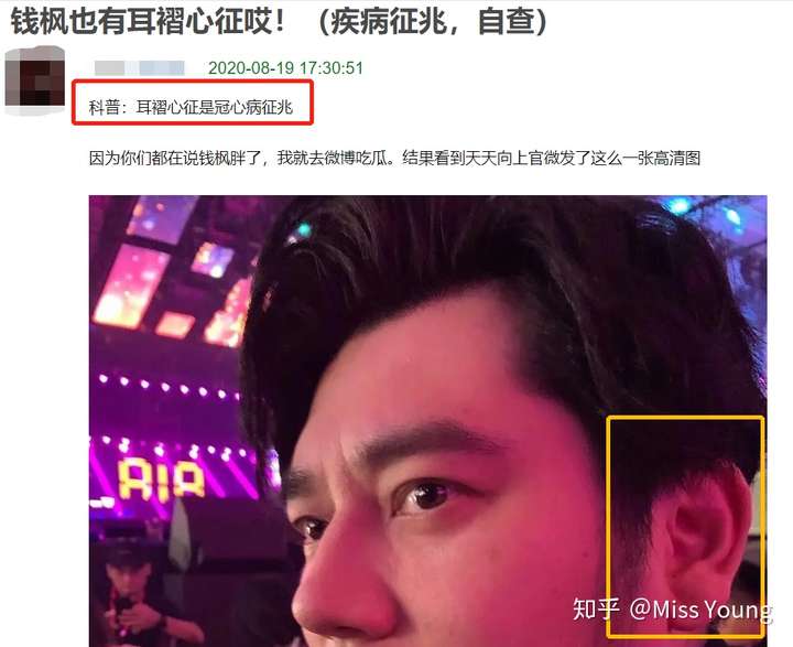 帖子里面"科普"了 耳褶心征(耳垂上有褶子)是冠心病的征兆.