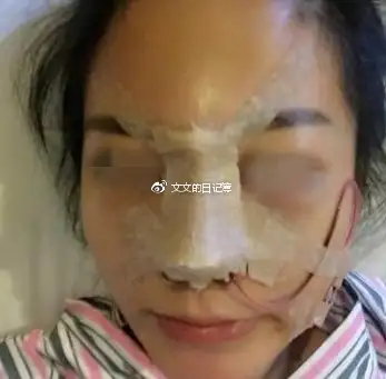 膨体和硅胶隆鼻哪个好_隆鼻硅胶膨体_隆鼻用硅胶好还是膨体好