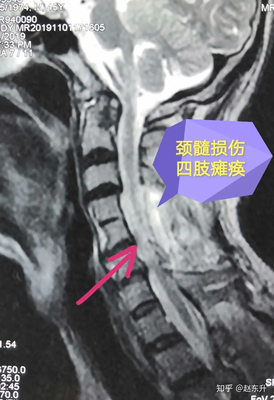 颈髓损伤四肢瘫痪真的没救了吗？ - 知乎