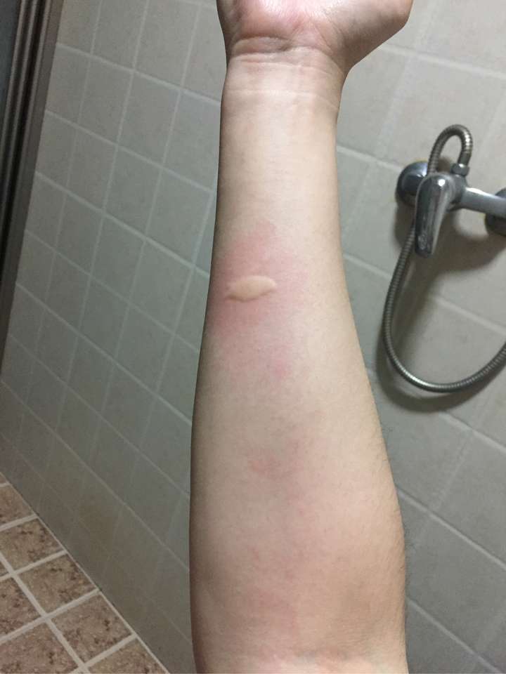 蚊子咬完就过敏怎么破?