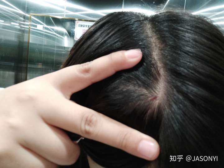 头皮刺痛 知乎