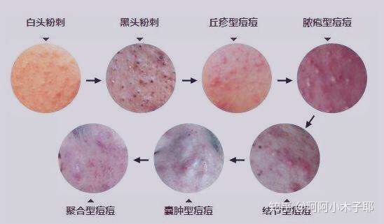 闭口类型图解图片