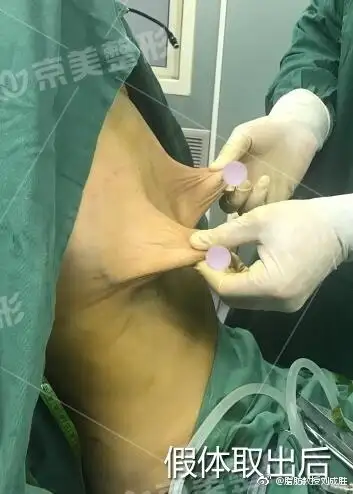 隆胸假体取出后很丑