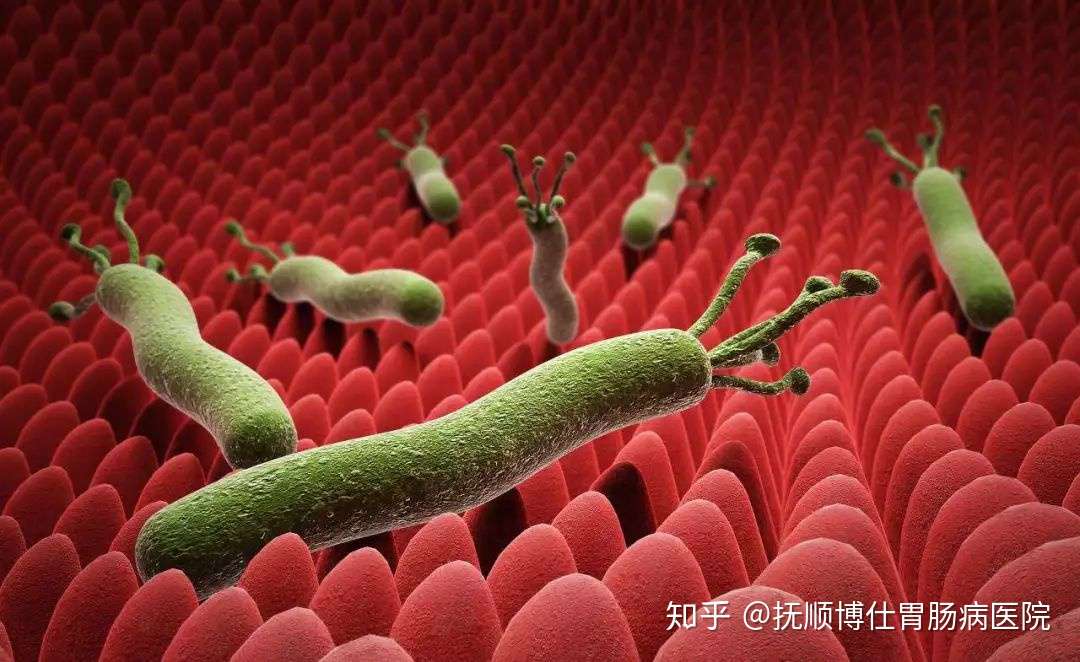 染上了幽门螺旋菌 会有3个症状 但很多人都很容易忽视 知乎