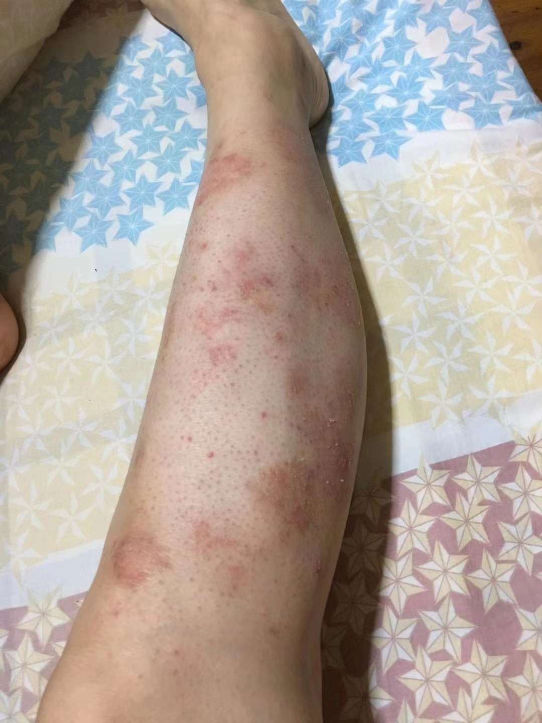 肤本堂皮肤病医院 的想法: 天气暖和,皮肤可以受到紫外线的照射,紫
