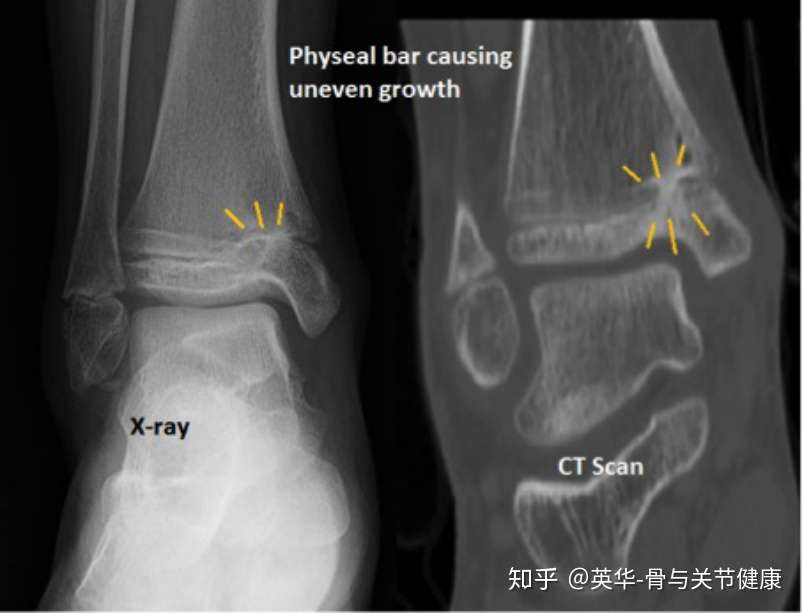 生长板骨折 损伤 Growth Plate Physeal Fractures 知乎