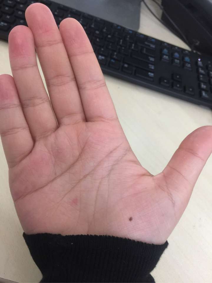 我的左手掌心有颗痣,突然很想找到右手掌心相同位置也有痣的人?