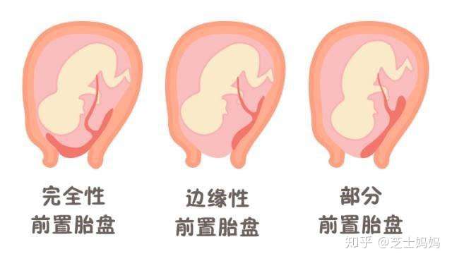 那些和胎盘有关的常见问题 答案都在这里 知乎